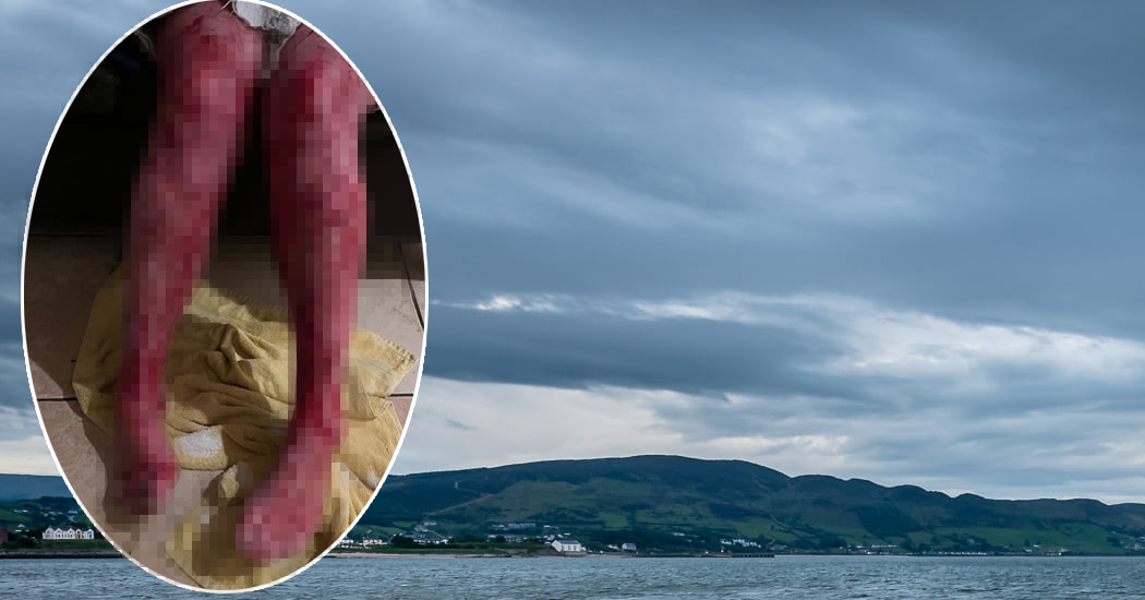 Warning: Local Woman’s Shocking Injuries from Sea Dipping Highlight Hypothermia Dangers